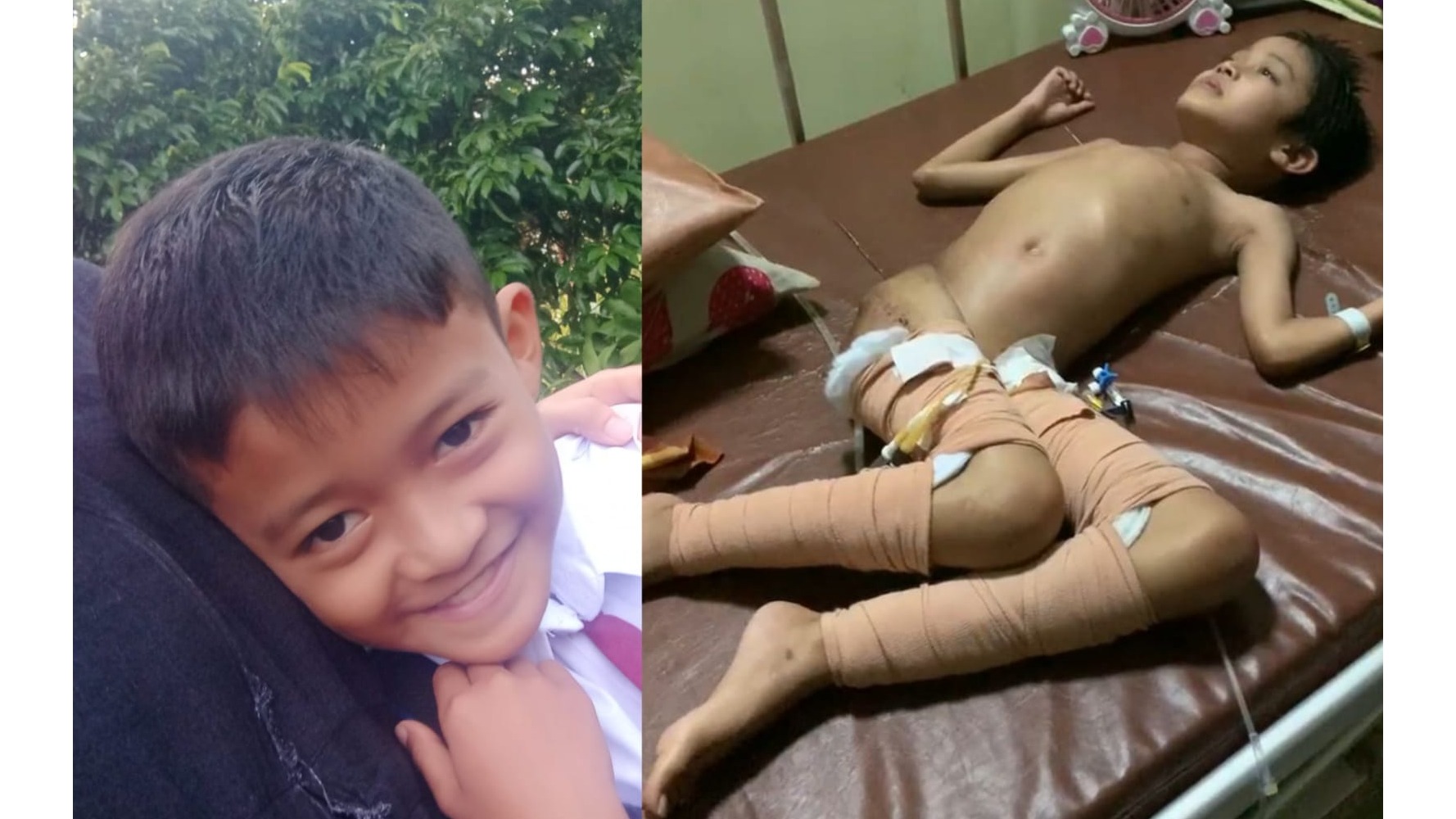 Bantu Reza Berjuang Melawan Tumor Tulang Belakang - 18564