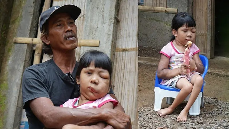 Bantu Salsabila yang Sejak Lahir Hidup dalam Rasa Sakit