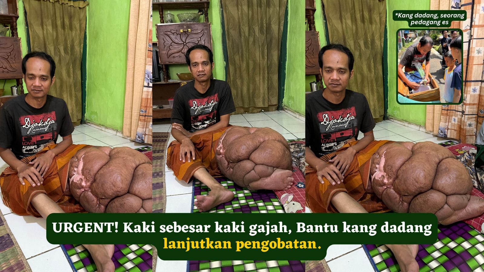 Kaki sebesar kaki gajah bantu kang dadang berobat - 23071