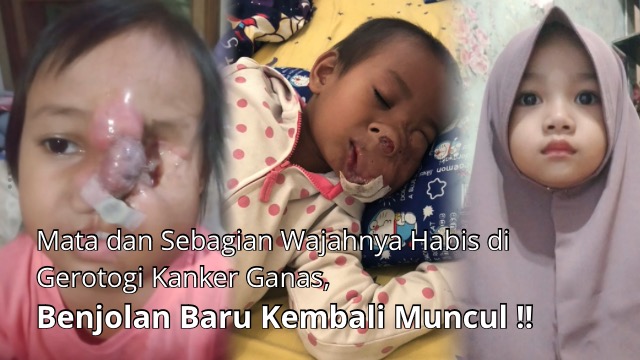 Bantu Asha Melawan Kanker Yang Menggerogoti Wajahnya - 21946