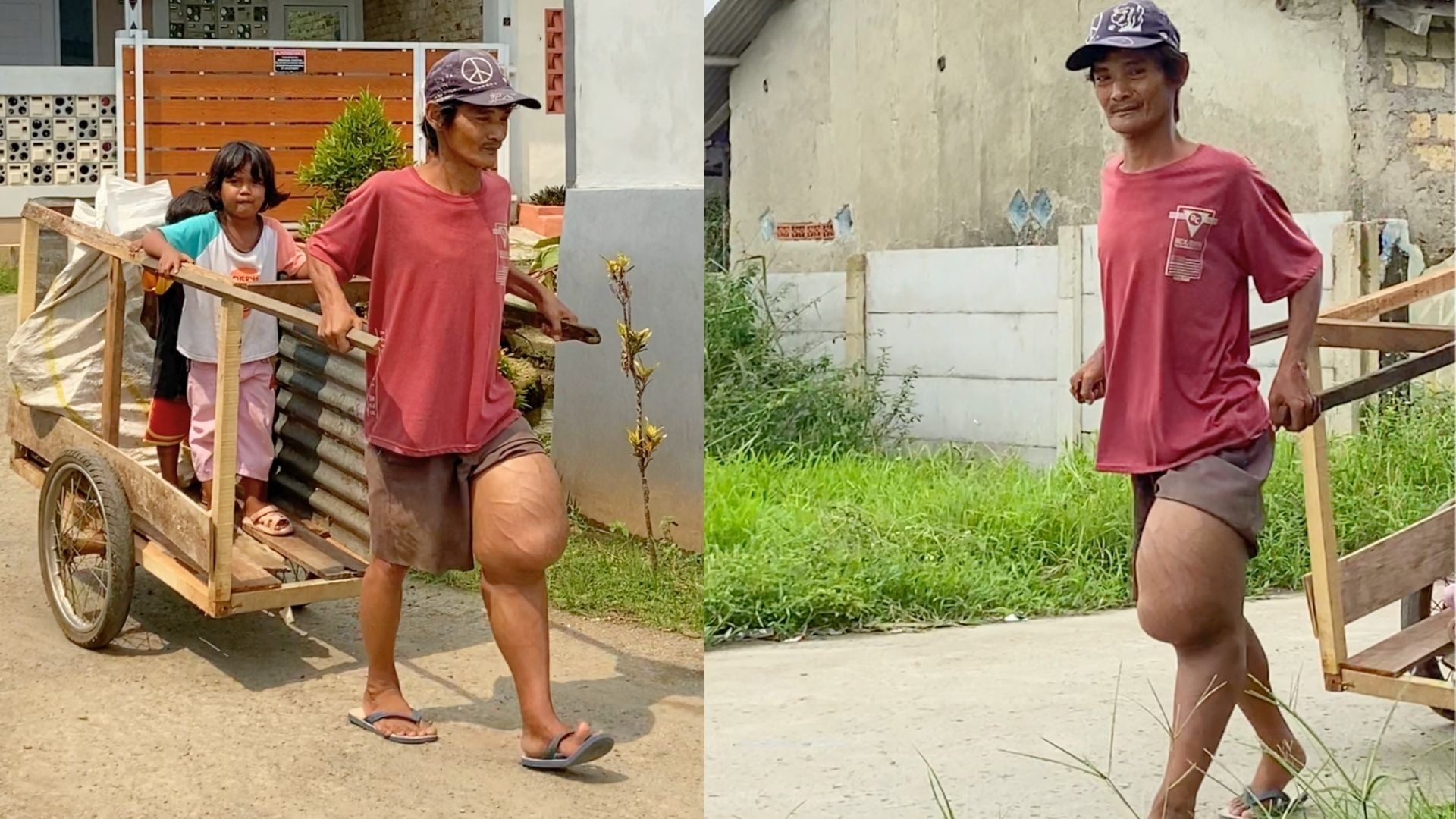 Tumor Kaki Sebesar Galon Bantu Pak Adang Sembuh - 20428