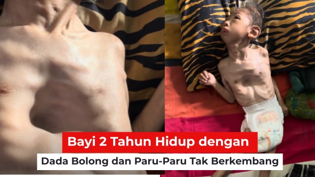 Bayi Hidup dengan Dada Bolong dan Paru Tak Berkembang - 22706