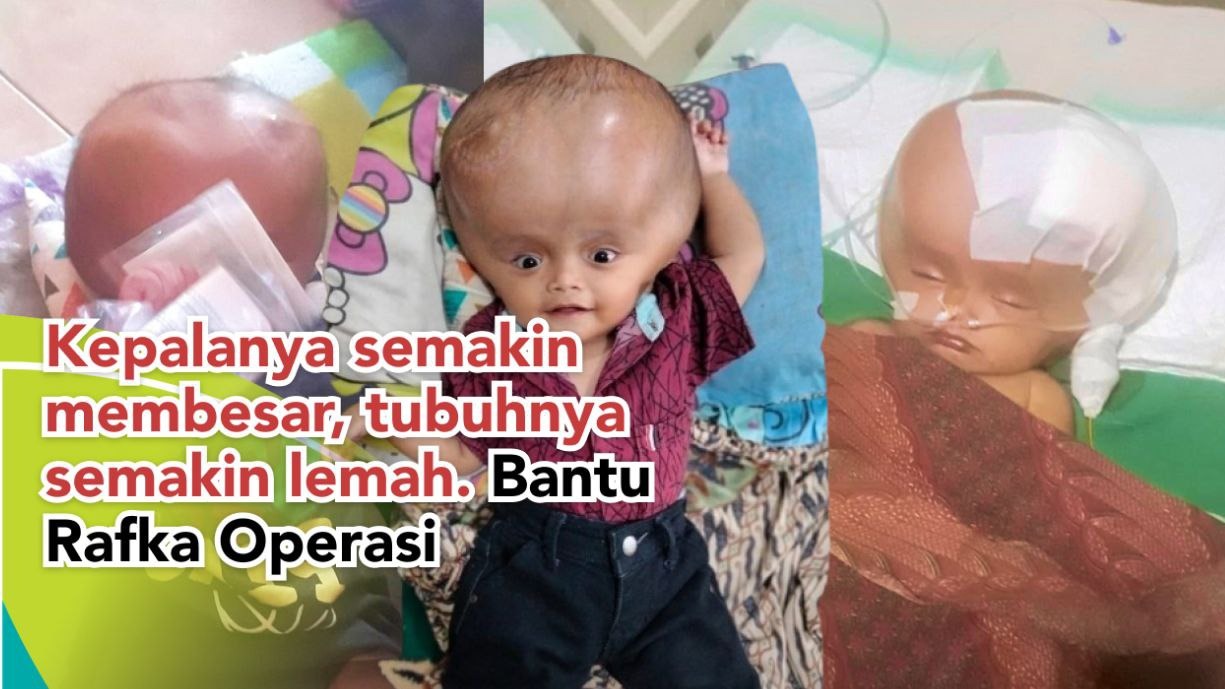 Kepala Semakin Membesar Rafka Butuh Operasi Sekarang - 22009