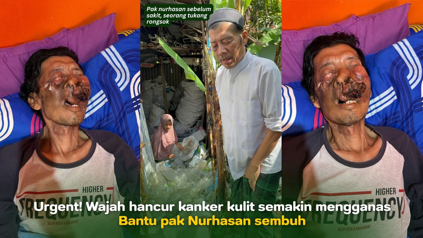 Wajah hancur karna kanker kulit bantu pak nurhasan