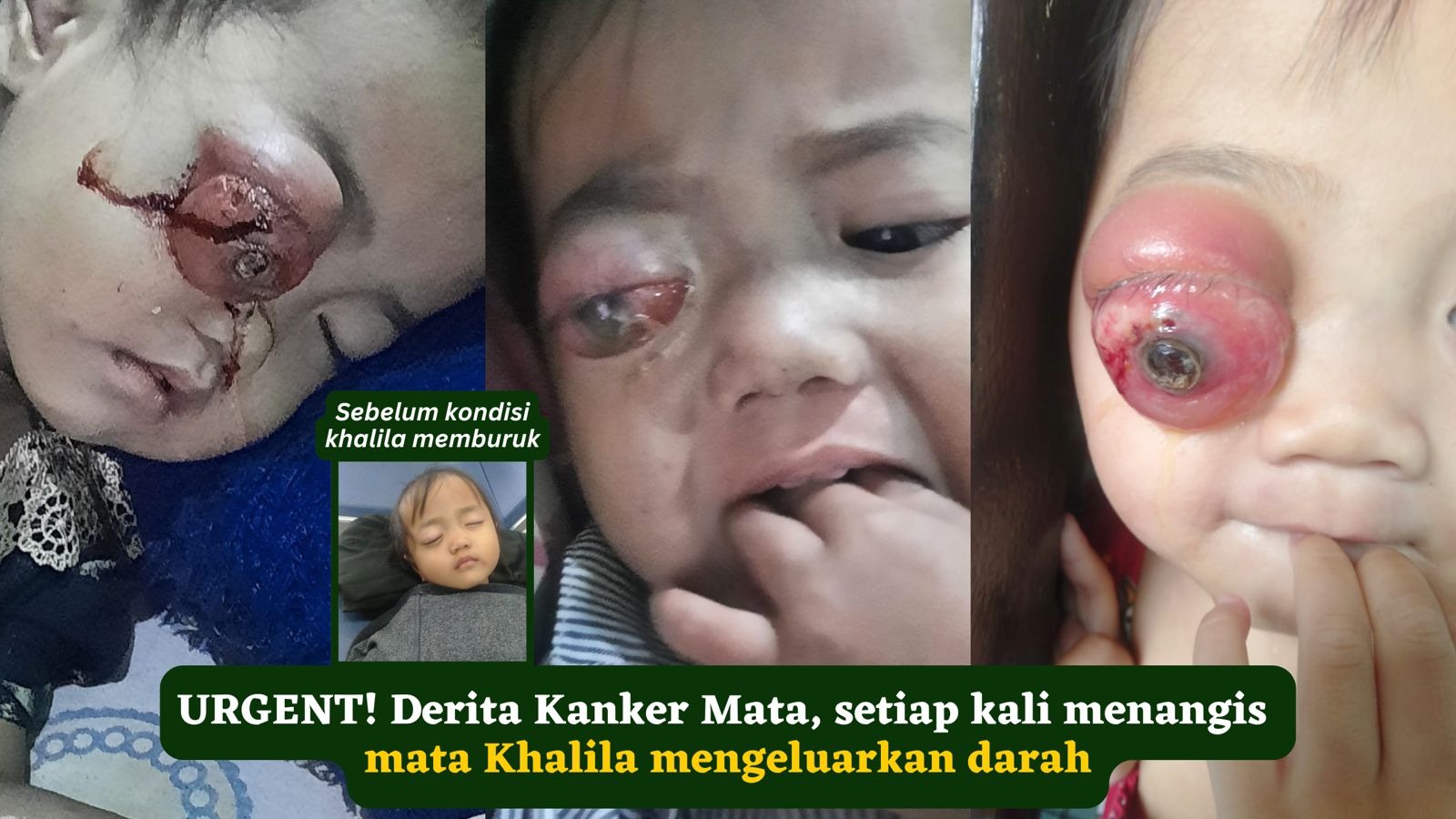Derita Kanker Mata tiap menangis mata Khalila berdarah - 23074
