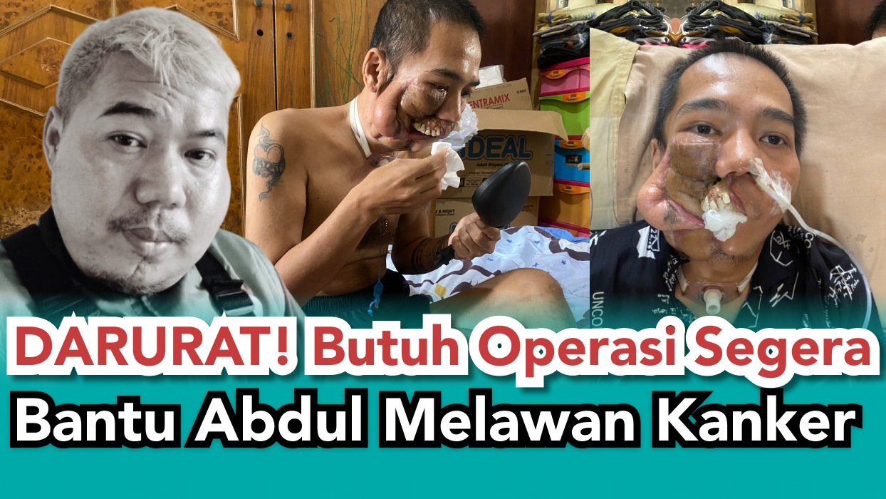 Kanker Rahang Mengancam Bantu Abdul Jalani Operasi - 20239