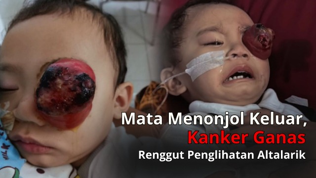 Mata Menonjol Karena Kanker Al Butuh Pertolongan - 20786