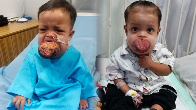 Tumor Lidah Semakin Membesar Bantu Zian Bisa Operasi