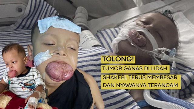 Tumor Lidah Membesar Ancam Nyawa Shakeel