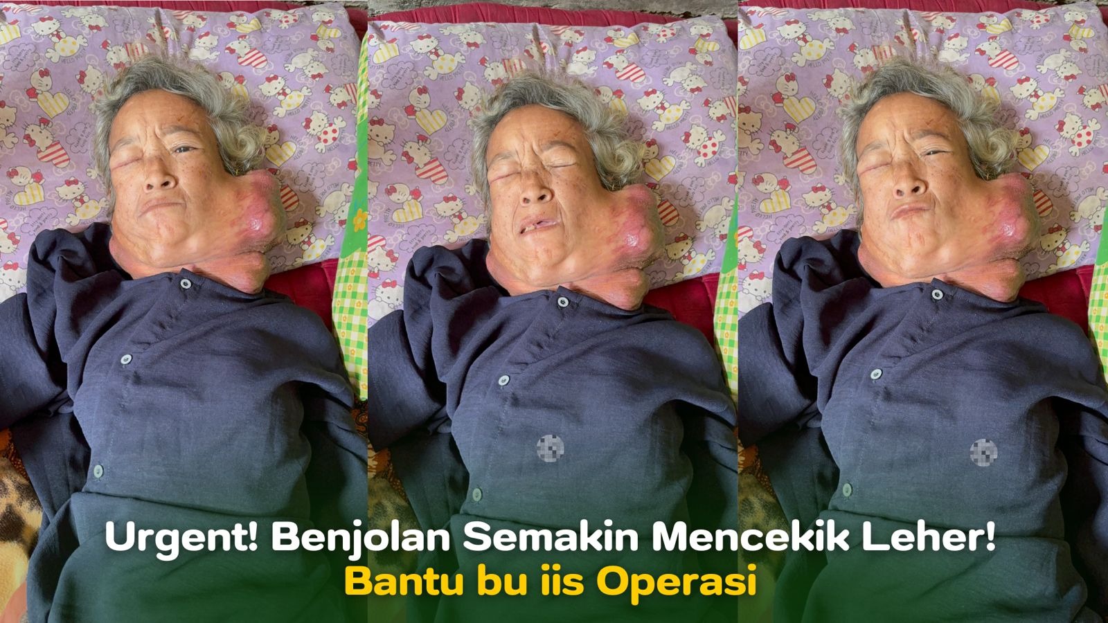Benjolan Semakin Mencekik Leher Bantu bu iis Operasi - 21386