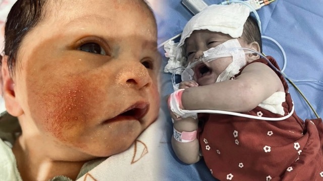 Bayi Mengidap Komplikasi! Butuh Biaya Pengobatan Segera