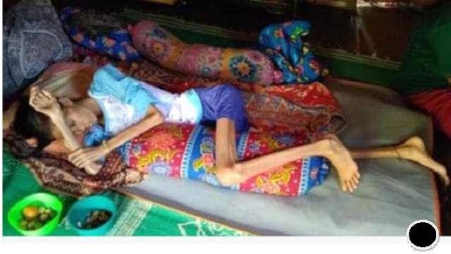 Bantu Afri sembuh dari sakit Marasmic kwashiorkor - 7826