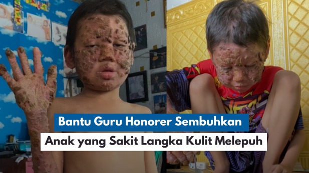 Bantu Ibu Guru Honorer Sembuhkan Anak yang Sakit Langka - 19393