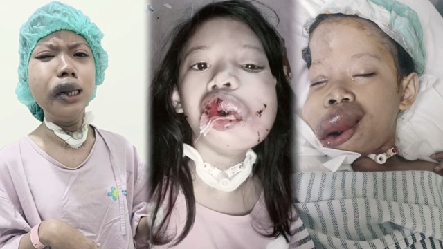 Dibully Karena Wajahnya Hasna Butuh Operasi Segera - 22166