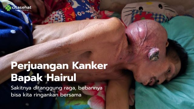 Pak Hairul Melawan Kanker Ganas di Tengah Keterbatasan - 21981