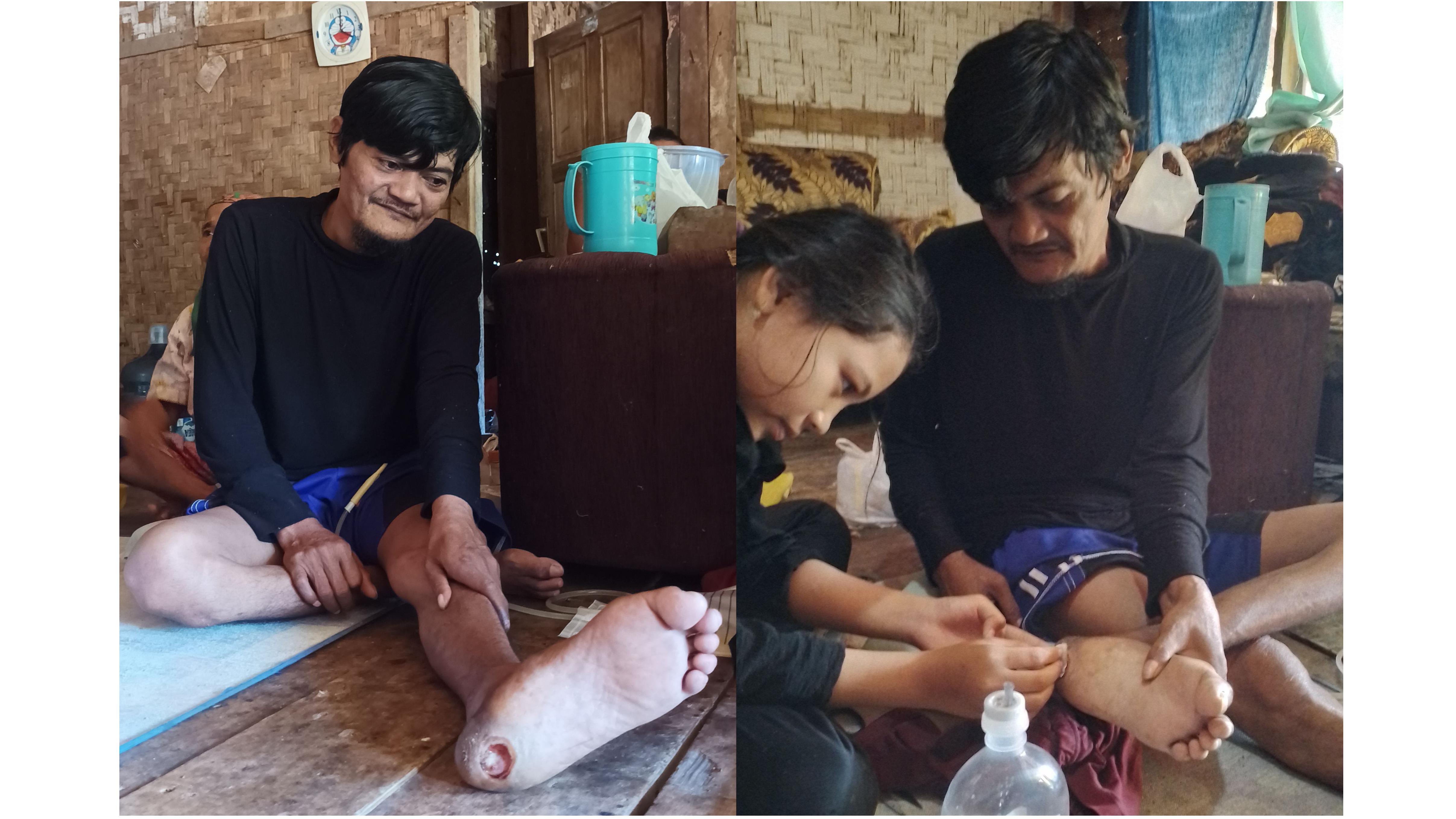 Jatuh dari pohon kelapa Kini ku tak bisa menafkahi keluargaku lagi - 15528