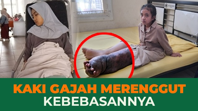 Selamatkan Kaki Tiara dari Penyakit Kaki Gajah - 21492