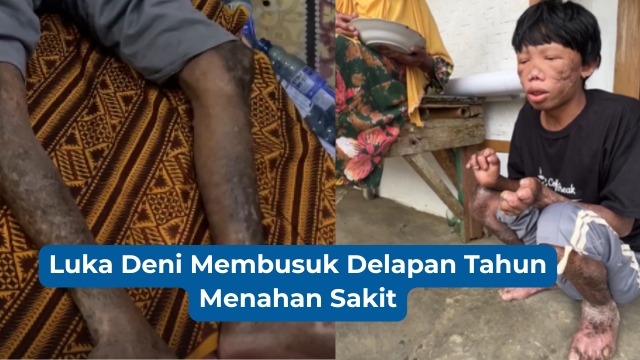 Luka Deni Membusuk Delapan Tahun Menahan Sakit - 22202
