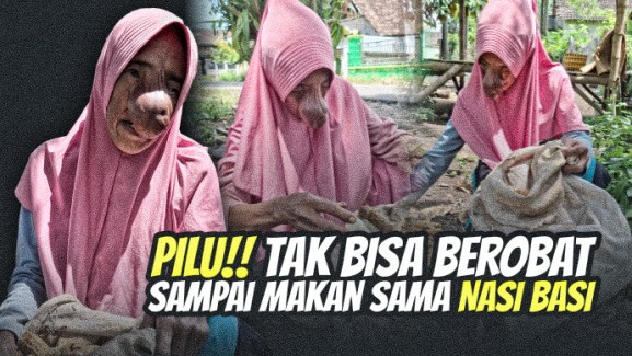 Benjolan Makin Membesar Pencari Bonggol Ini Idap Tumor - 21928
