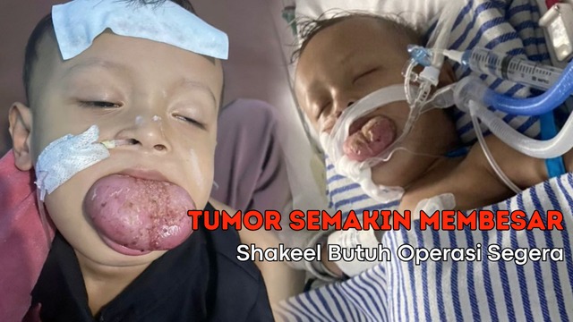 Tumor Lidah Terus Membesar, Bantu Shakeel Sembuh