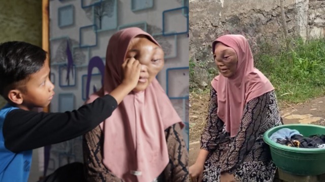 Bantu Perjuangan Single Mom Idap Tumor di Wajah - 22599