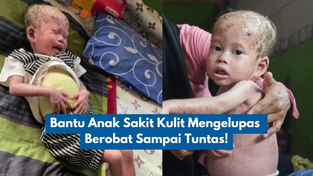 Bantu Anak Sakit Kulit Mengelupas Berobat Sampai Tuntas - 20951