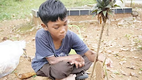 Wujudkan Mimpi Kecil Zildan Yang Tertahan Luka Bakar - 21749