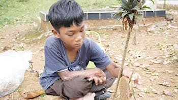 Wujudkan Mimpi Kecil Zildan Yang Tertahan Luka Bakar