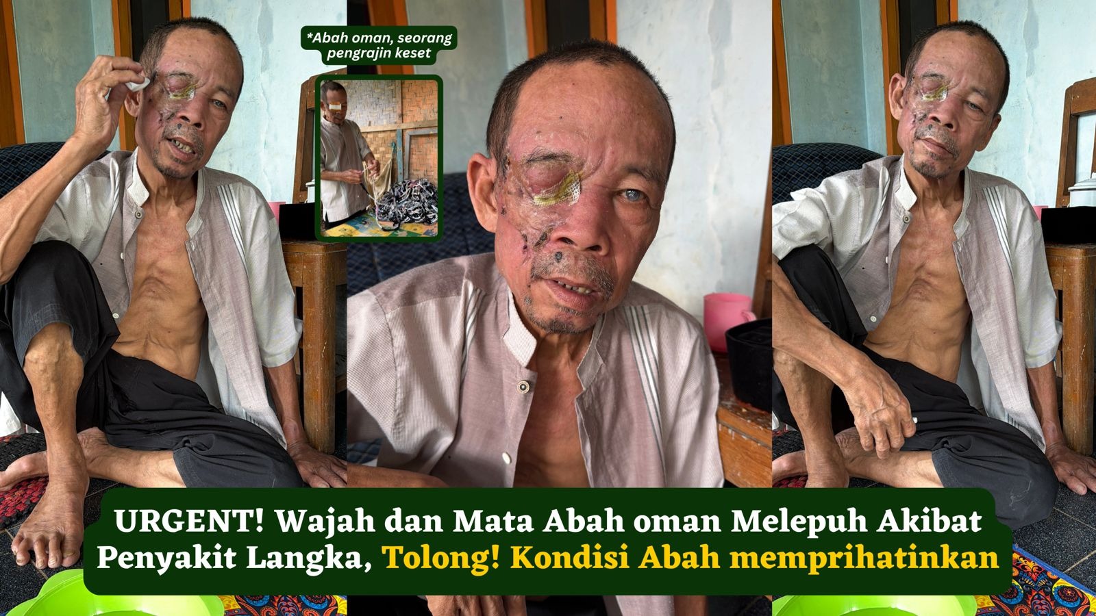 Wajah Melepuh karna Penyakit Langka Tolong abah Oman - 23073