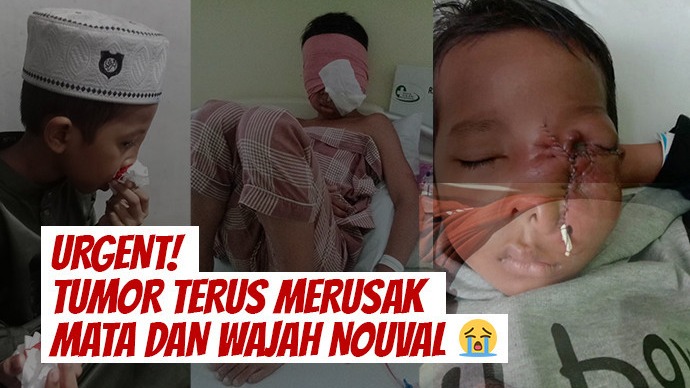 Tumor di Wajah Bantu Nouval Berjuang Untuk Sembuh - 21620