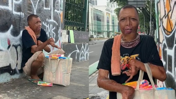 Luka Bakar Parah Tak Hentikan Perjuangan Seorang Ayah! - 22116
