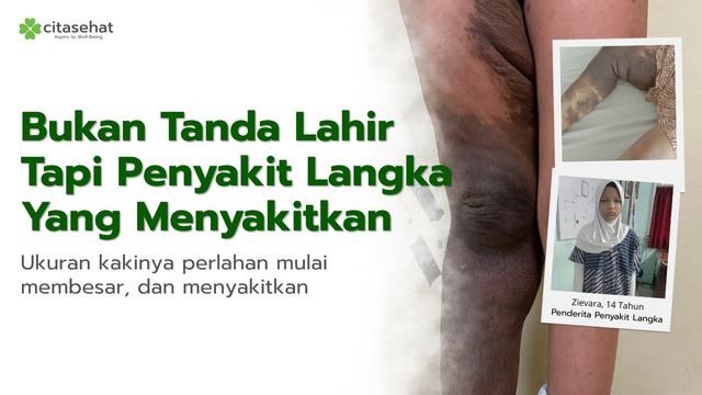 Bantu ZIEVARA penderita penyakit Langka - 21552