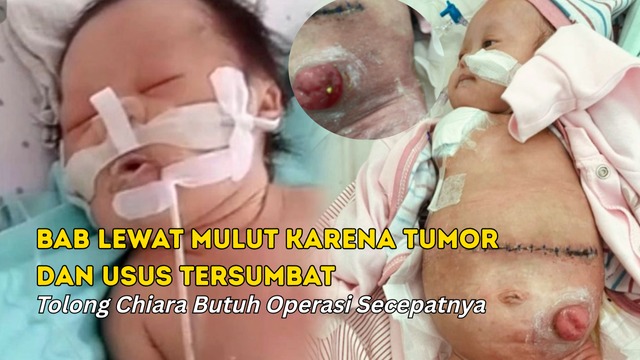 Bantu Chiara Lawan Tumor Ganas dan Down Syndrome - 22171