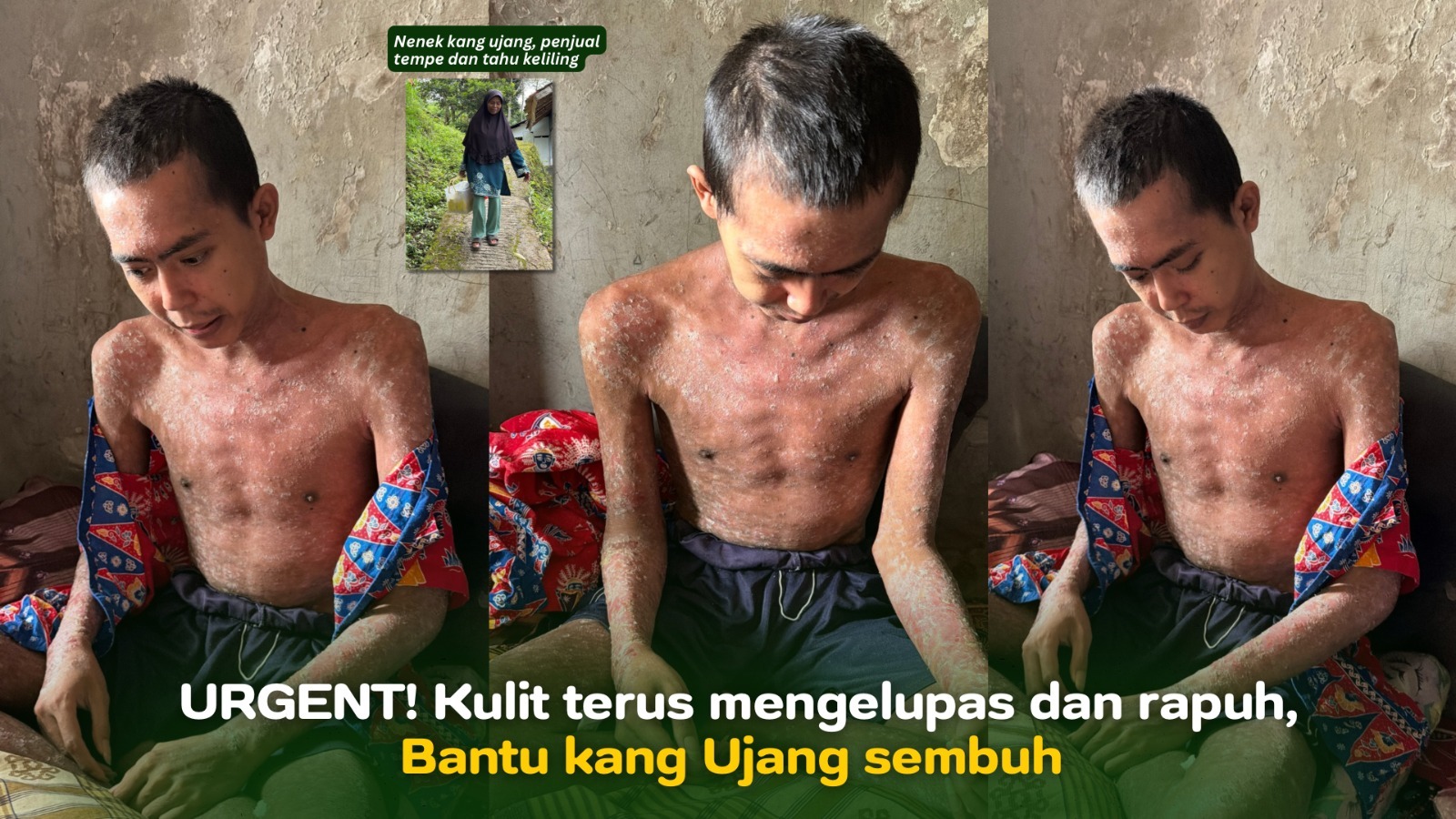 Kulit mengelupas dan rapuh Bantu kang Ujang Sembuh