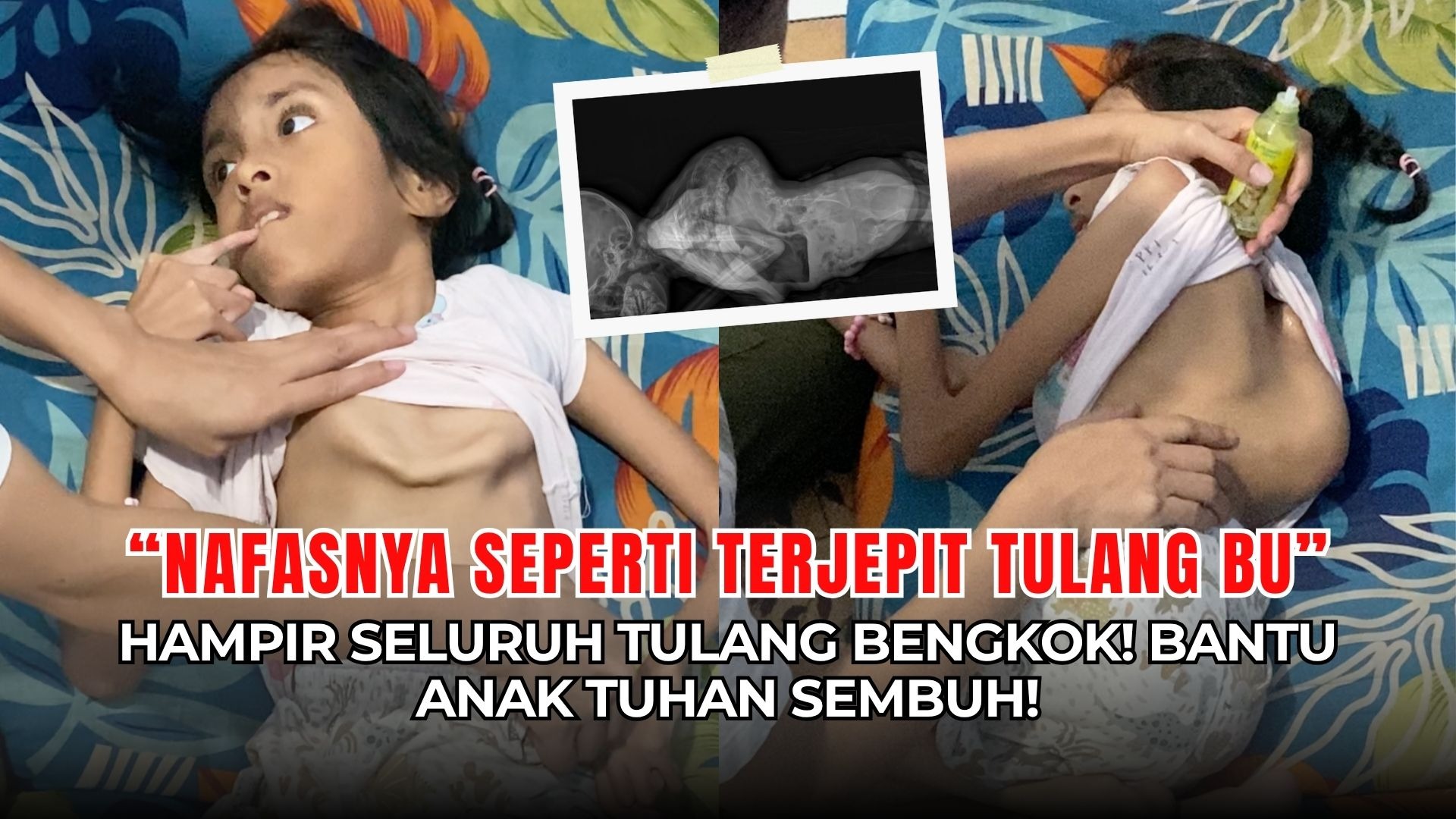 Nyawa Chelsea Terancam! Tulang Bengkok Tekan Jantung! - 22339