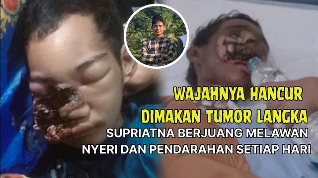 Tumor Langka Hancurkan Wajah Supriatna