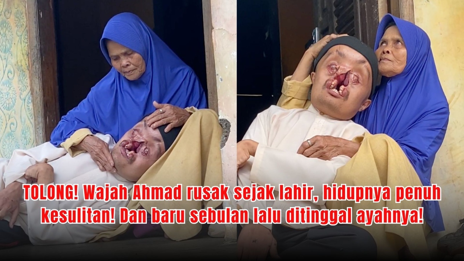 Wajah Hancur Tak Jadi Penghalang Solihin Tetap Berbakti - 22297