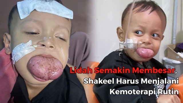 Tumor Lidah Terus Membesar, Bantu Shakeel Sembuh - 21010