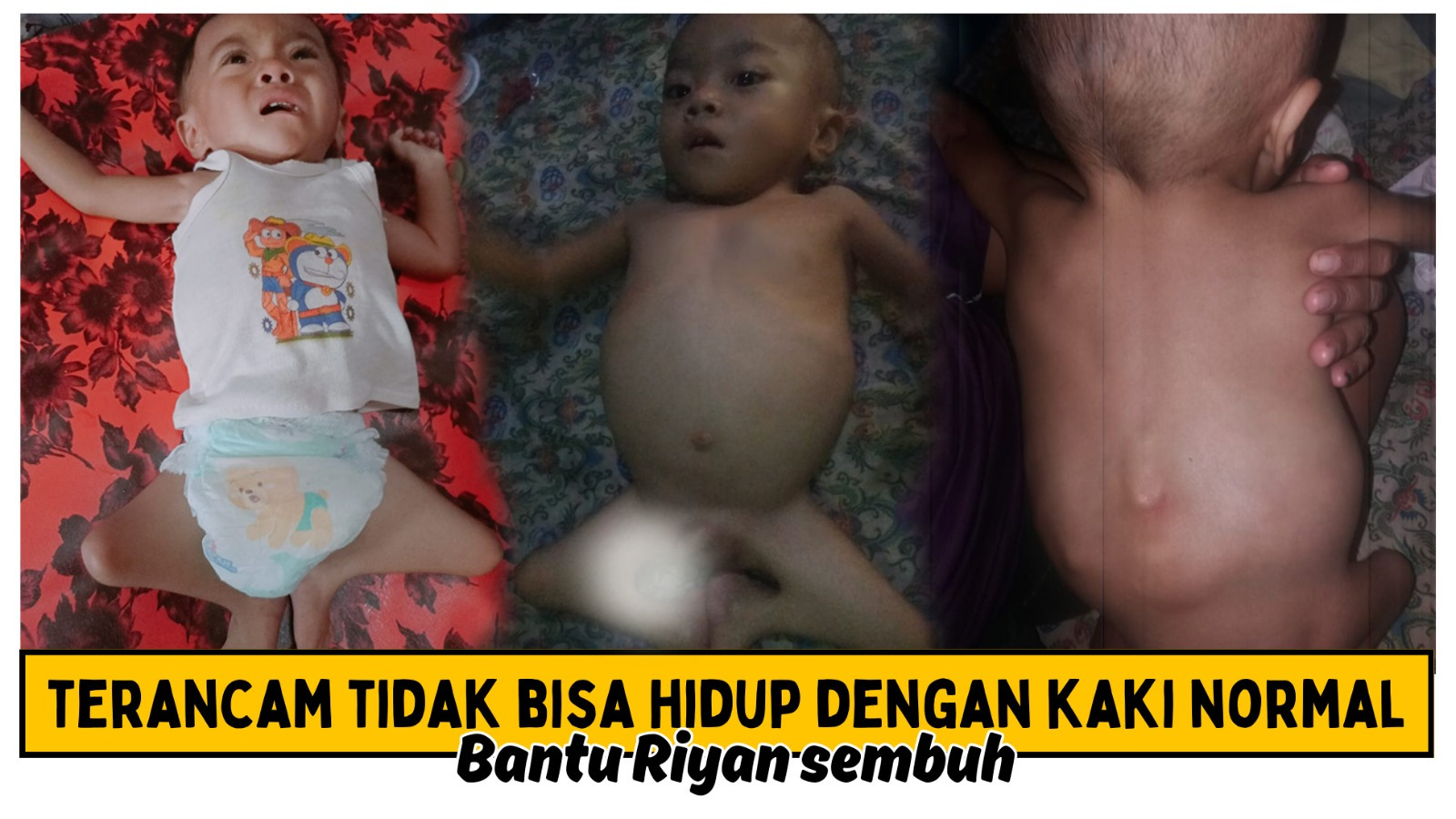 Kaki Cacat Bantu Riyan Sembuh - 21472