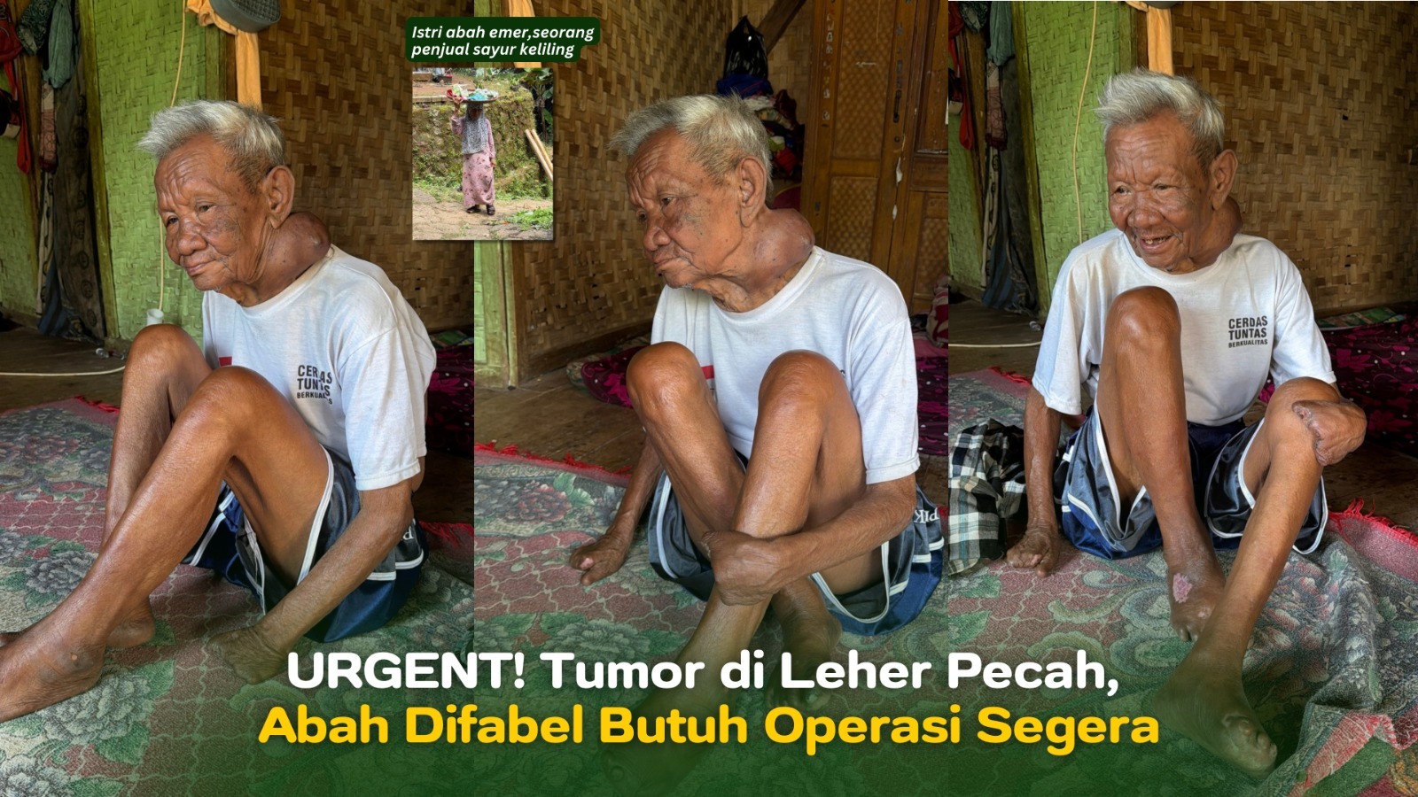 Tumor di Leher Pecah Abah Difabel Butuh Operasi Segera