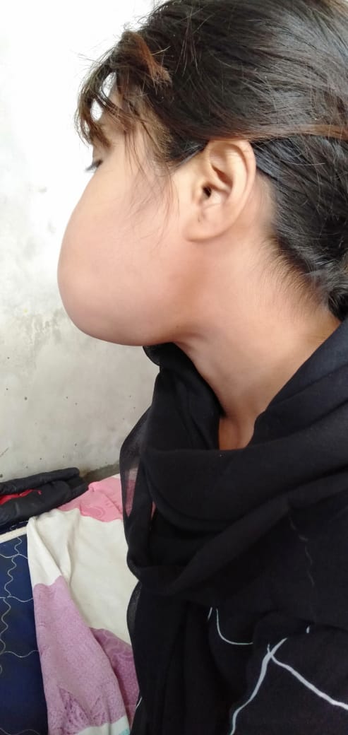 rahangnya yang terus membesar dan ketika nyeri kambuh sakit di rahangnya seperti mau lepas